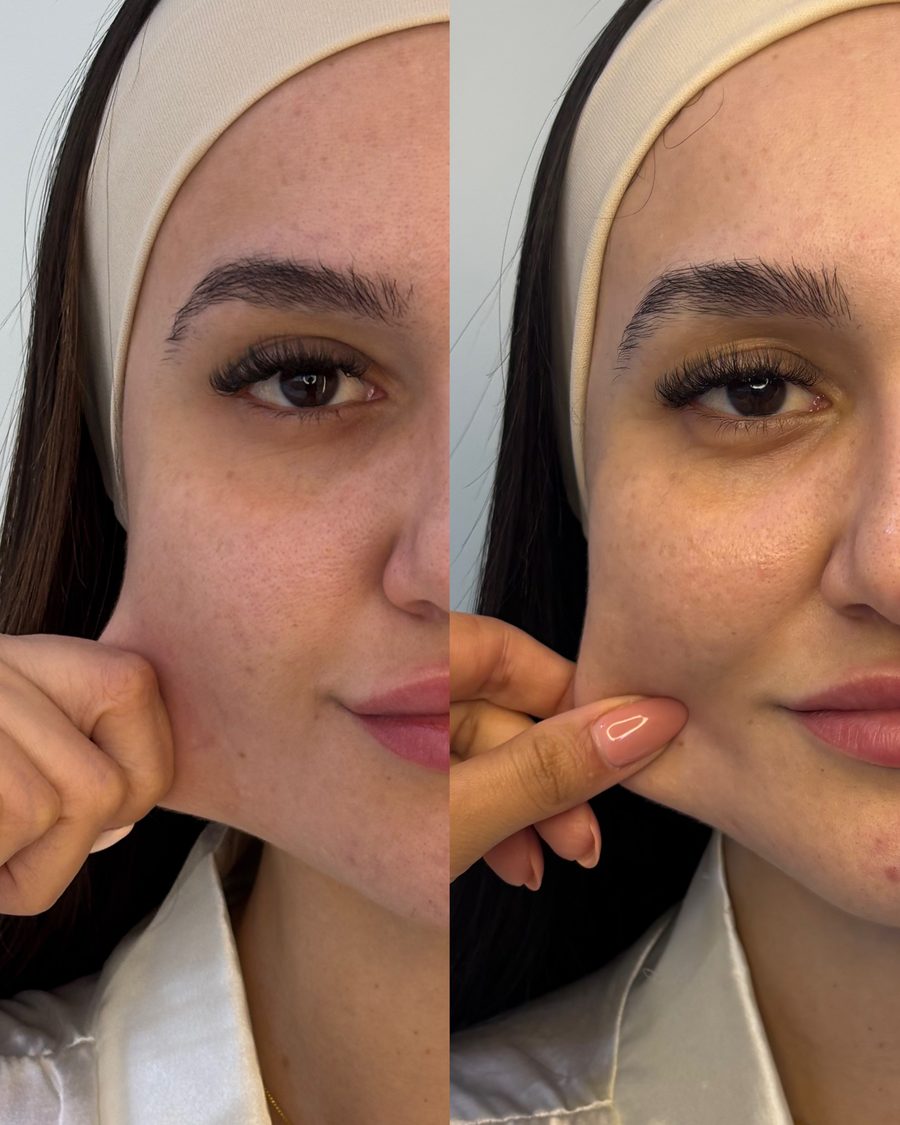 Antes e depois de bioestimulador de colágeno