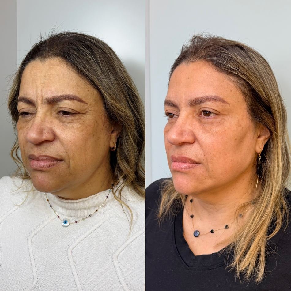 Antes e depois de harmonização facial full face — segunda paciente, vista oblíqua