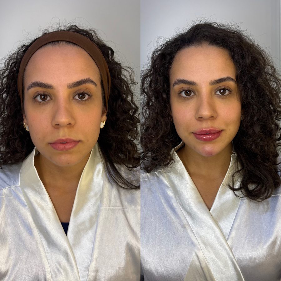 Antes e depois de preenchimento labial